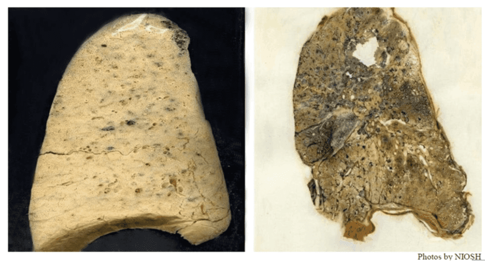 Comparison of two lungs: on the left is a healthy lung with light coloration; on the right is a diseased lung with darker spots and discoloration.